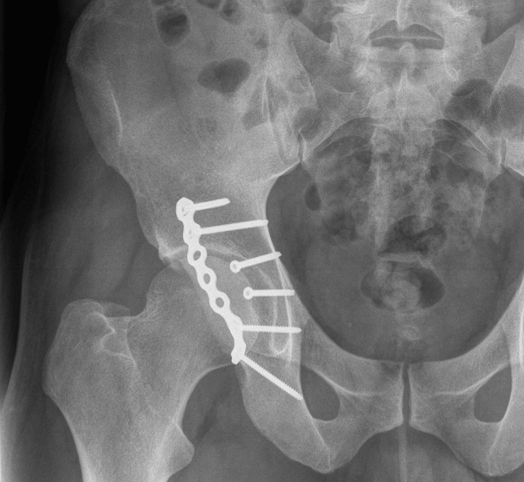 Acetabulum Posterior Wall Plating 1